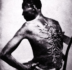 Cicatrices de flagellation sur un esclave 